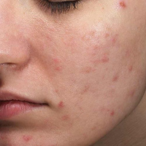 acné inflammatoire - avant