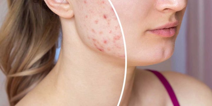 traitement de l’acné inflammatoire